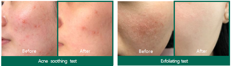 SOMEBYMI AHA-BHA-PHA Miracle Acne Clear Foam