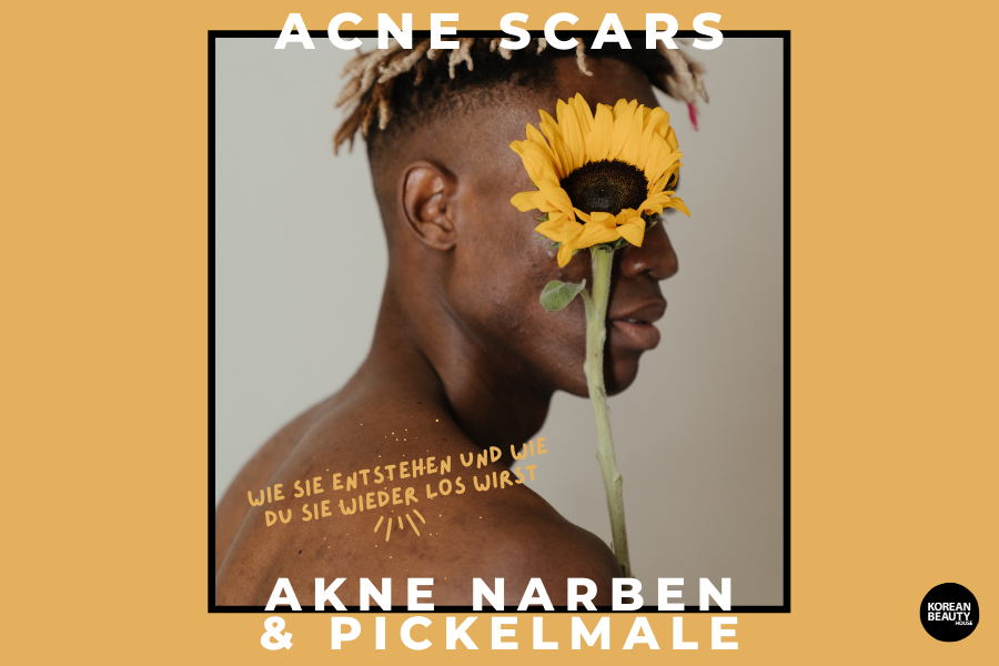 Acne Scars – Warum Akne Narben und Pickelmale entstehen und wie du sie wieder los wirst