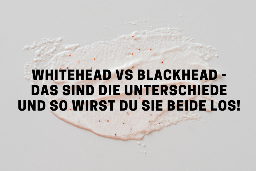 Whitehead vs blackhead - Das sind die Unterschiede und so wirst du sie beide los!